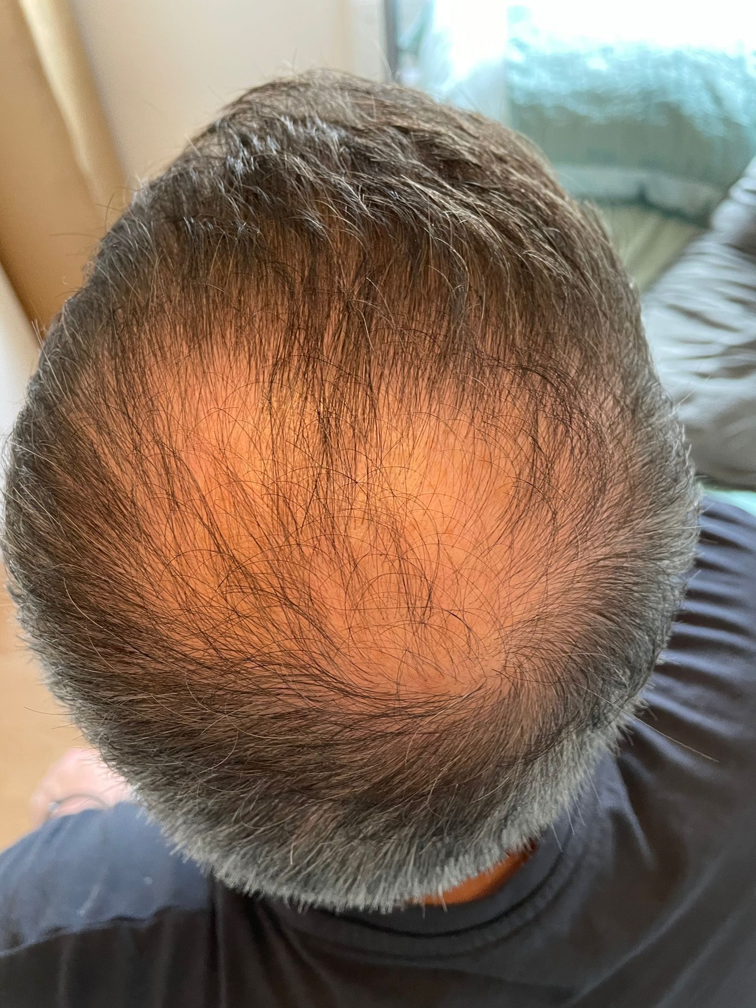 A picture of a male with male pattern baldness around the crown area