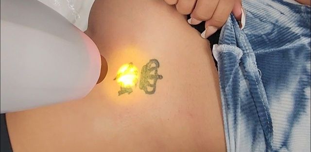 First session of laser tattoo removal ⚡️ #lasertattooremoval #tattoore... |  TikTok