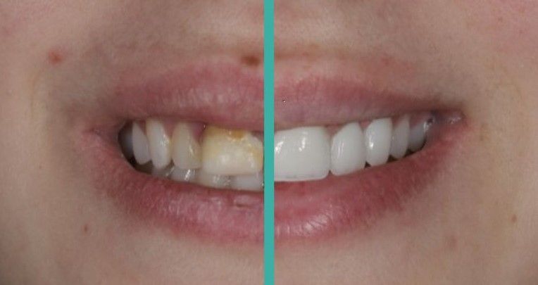a close up of a woman 's teeth before and after whitening .