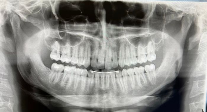 a black and white x-ray of a person 's teeth .