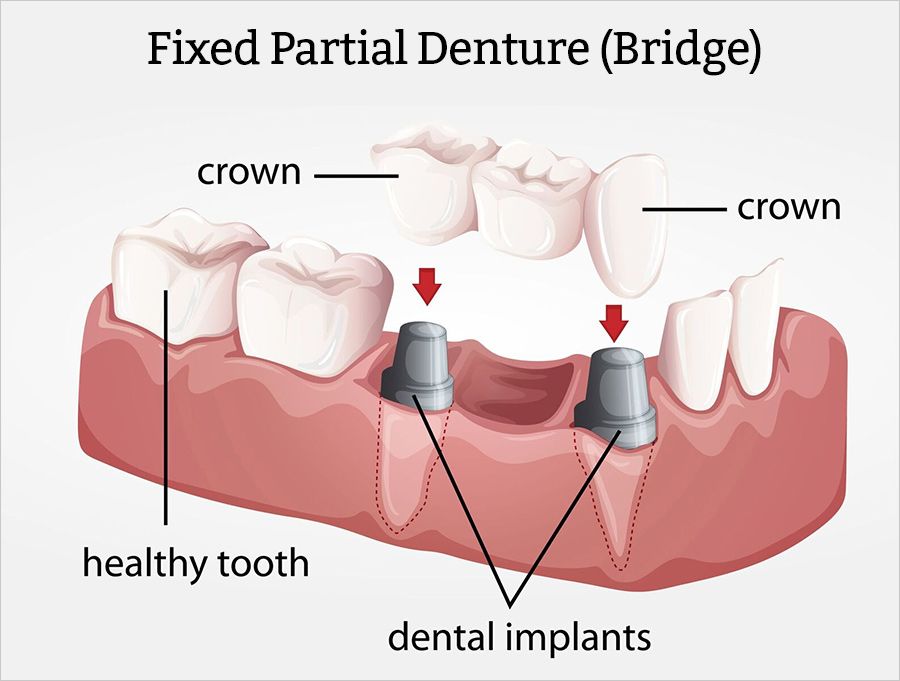 a diagram of a fixed partial denture bridge with a healthy tooth and dental implants .