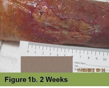 Foot with a deep, red ulcer on the ball, with slight discoloration; week 2 of treatment.