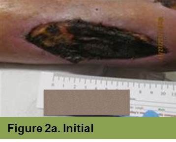 Foot with open wound on big toe. The wound has red tissue and a yellow-white border.