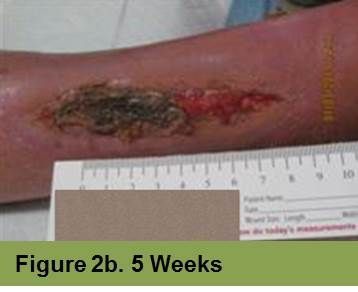 Foot with a deep, red ulcer on the ball, with slight discoloration; week 2 of treatment.