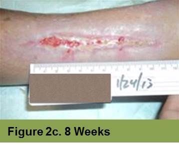 Foot with an open sore on the toe, showing redness and potential tissue damage; the image has a week 5 caption.