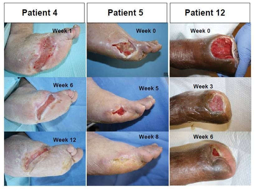 Foot ulcer healing progress, shown for three patients over several weeks.