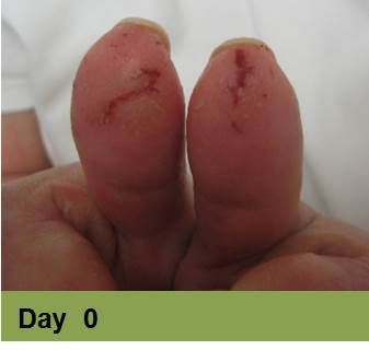 Foot with a deep, red ulcer on the ball, with slight discoloration; week 2 of treatment.