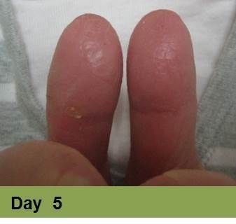 Foot with open wound on big toe. The wound has red tissue and a yellow-white border.