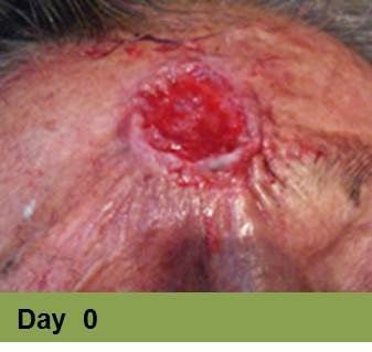 Foot with a deep, open wound and a ruler for scale. The wound has exposed tissue with a yellow edge.