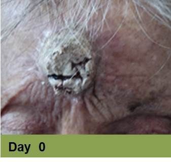 Close-up of a wound on skin, with ruler for scale.  Wound is open, bloody, surrounded by inflamed, discolored skin.