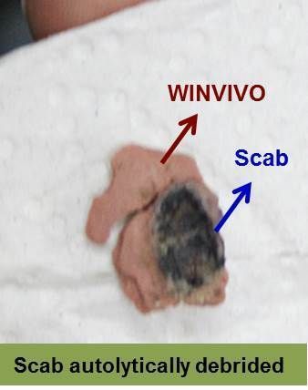 Foot with a wound on the toe, appears to be healing. Text reads 