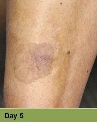 Foot with an open wound, Week 2. Skin is torn, revealing red flesh.