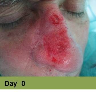 Foot with deep, open ulcer. Skin is swollen and discolored.  The ulcer is reddish with exposed tissue.