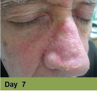 Wound on leg, Week 4.  The open sore is reddish-brown with surrounding pale skin.