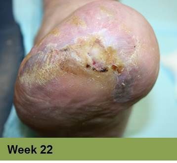 Heel with a large, open sore, showing signs of tissue damage. The surrounding skin is discolored.