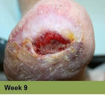 A close-up of a foot with a deep, open wound. Red, raw tissue visible. “Week 9” is in a green bar below.