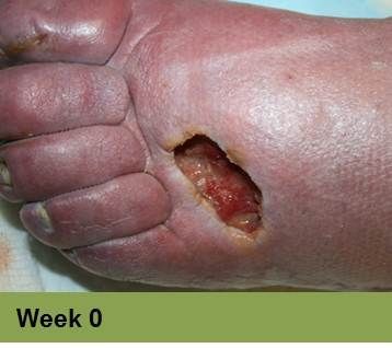 Foot with deep, open ulcer. Skin is swollen and discolored.  The ulcer is reddish with exposed tissue.