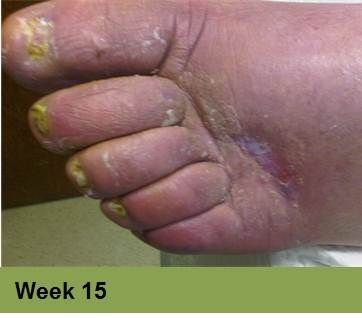 Foot with swollen toes, discolored nails, and signs of skin breakdown; labeled 