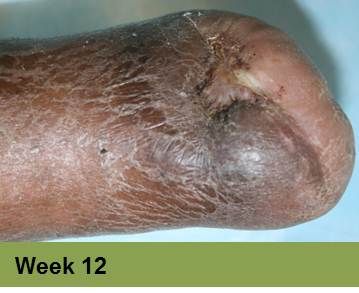 Heel with severely damaged skin, possibly a pressure ulcer, displaying dark discoloration. 