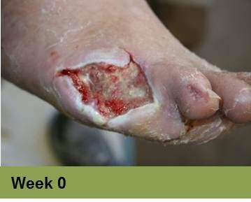 Foot with open wound, red tissue, and exposed bone; labeled 