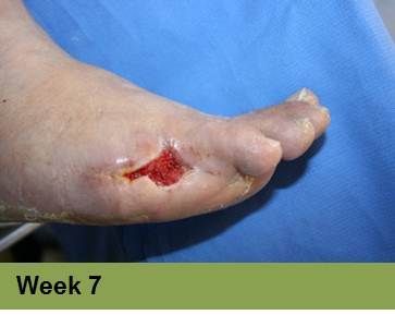 Foot with a wound on the toe, appears to be healing. Text reads 