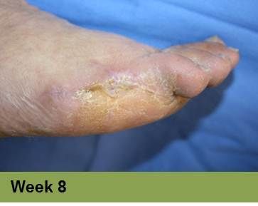 Foot with healed wound, likely diabetic ulcer, at 8-week mark. Skin is yellowed with scarring.