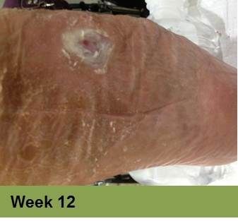 Close-up of a leg with a small, circular wound, white and pink, surrounded by dry, reddish skin.