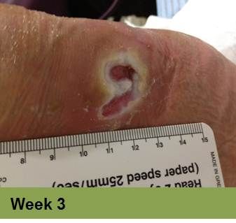 Foot with a deep, open wound and a ruler for scale. The wound has exposed tissue with a yellow edge.