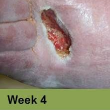 Wound on leg, Week 4.  The open sore is reddish-brown with surrounding pale skin.