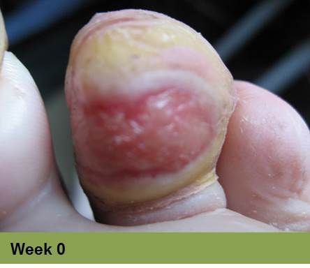 Foot with a deep, red ulcer on the ball, with slight discoloration; week 2 of treatment.