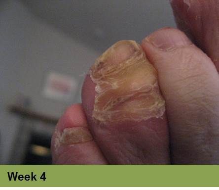 Foot with an open sore on the toe, showing redness and potential tissue damage; the image has a week 5 caption.