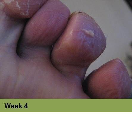 Foot with healing wounds, possibly diabetic, at week 6. Light skin, indoors setting.