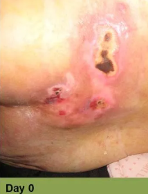 Close-up of a wound on skin, with ruler for scale.  Wound is open, bloody, surrounded by inflamed, discolored skin.