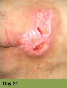 Foot with a deep, open wound and a ruler for scale. The wound has exposed tissue with a yellow edge.