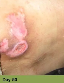 Hand with a healing wound, ruler, and bandage; week 7.