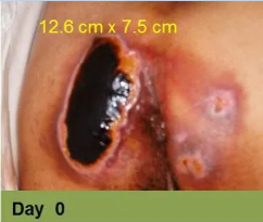 Foot with open wound on big toe. The wound has red tissue and a yellow-white border.