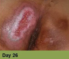 Foot with a deep, red ulcer on the ball, with slight discoloration; week 2 of treatment.