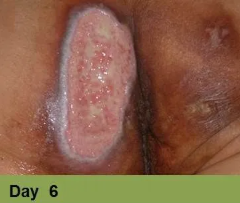 Foot with an open sore on the toe, showing redness and potential tissue damage; the image has a week 5 caption.