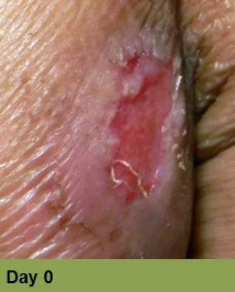 Foot with deep, open ulcer. Skin is swollen and discolored.  The ulcer is reddish with exposed tissue.