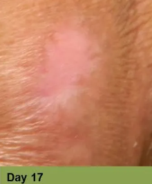 Wound on leg, Week 4.  The open sore is reddish-brown with surrounding pale skin.