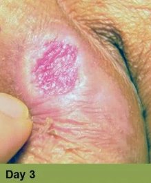 Foot with a deep, open wound, swollen toes, and discoloration.