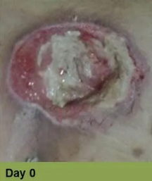 Foot with open wound, red tissue, and exposed bone; labeled 