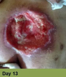 Foot with an open wound, Week 2. Skin is torn, revealing red flesh.