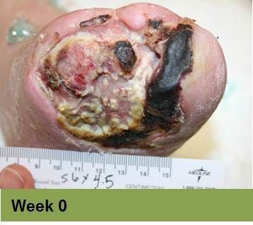 Foot with open wound on big toe. The wound has red tissue and a yellow-white border.