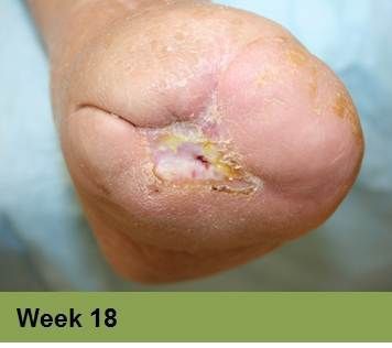 Foot with healing wounds, possibly diabetic, at week 6. Light skin, indoors setting.