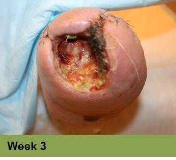 Foot with a deep, red ulcer on the ball, with slight discoloration; week 2 of treatment.