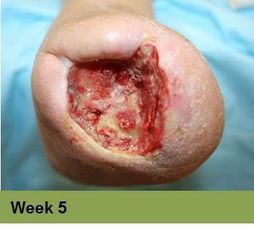 Foot with an open sore on the toe, showing redness and potential tissue damage; the image has a week 5 caption.
