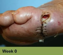 Foot with open wound on big toe. The wound has red tissue and a yellow-white border.