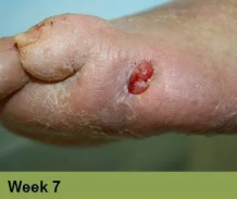 Foot with a deep, red ulcer on the ball, with slight discoloration; week 2 of treatment.