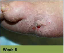 Foot with an open sore on the toe, showing redness and potential tissue damage; the image has a week 5 caption.